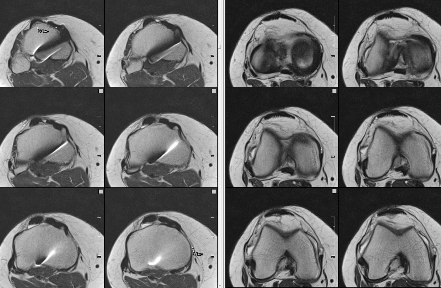 Figure 2 for case Soft tissue patellar-lowering procedure